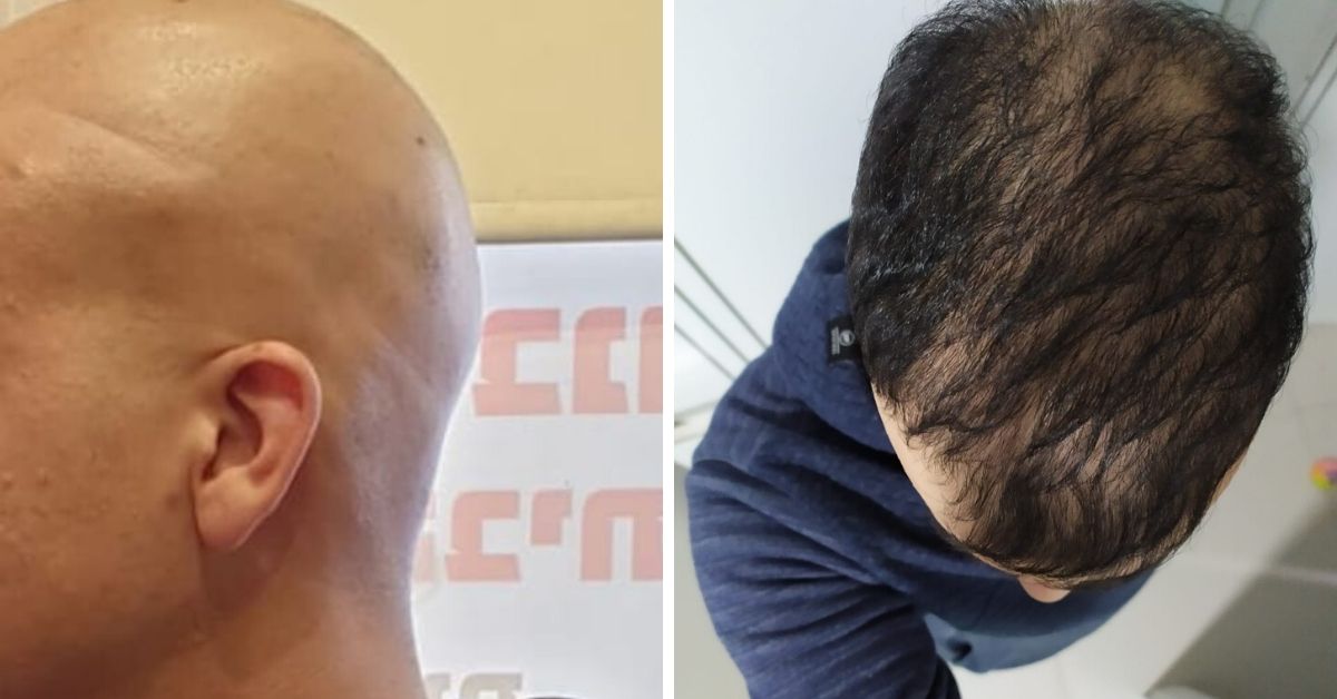 לפני ואחרי הטיפול