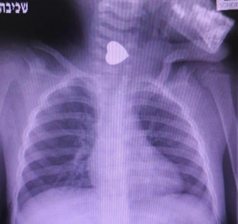 מגנט הלב בצילום הרנטגן | צילום: דוברות ביה"ח 'קפלן'